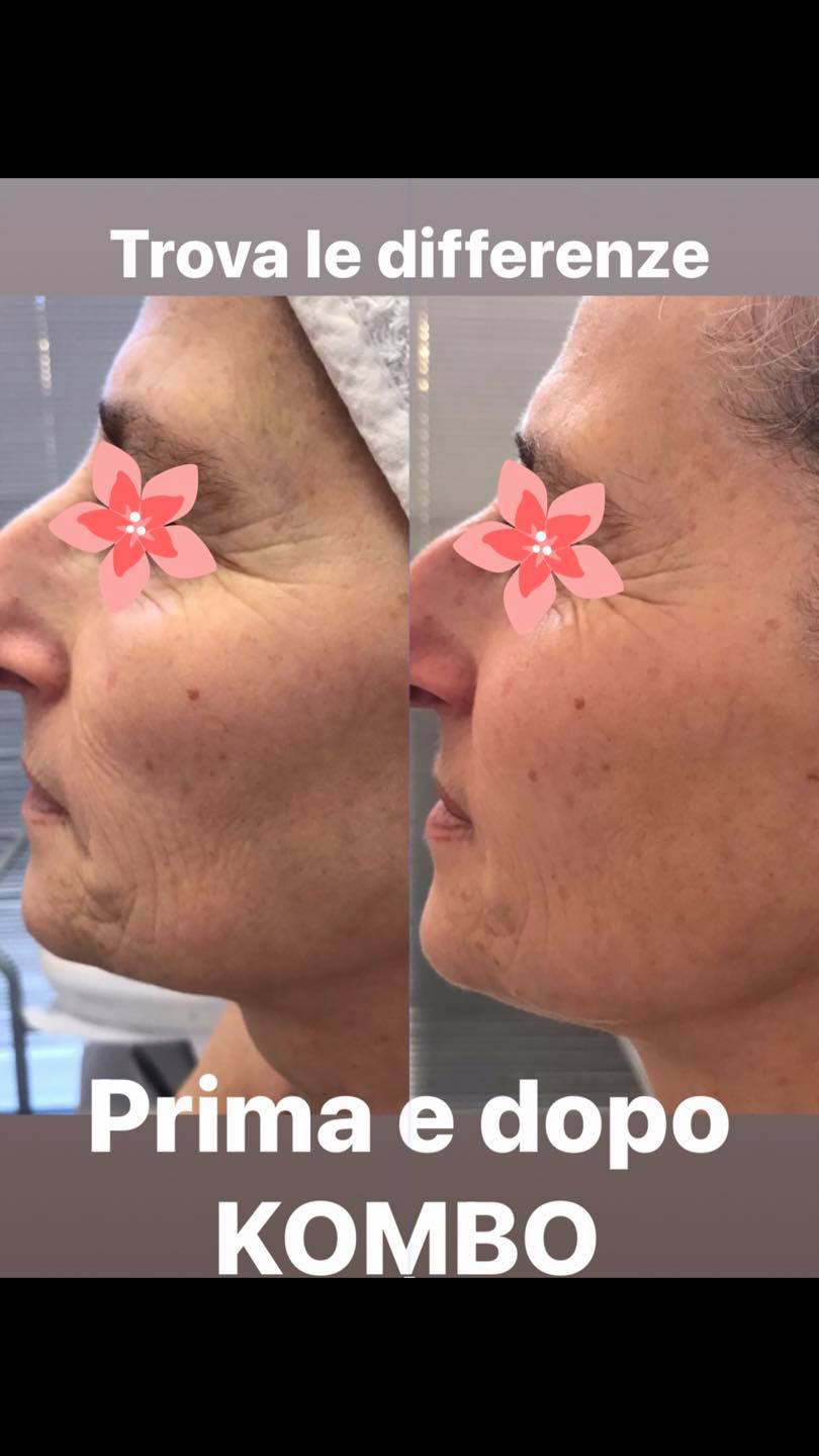 trattamento sopracciglia