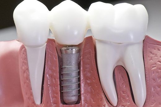 Modellino in plastica che mostra due denti normali e uno con vite al posto della radice
