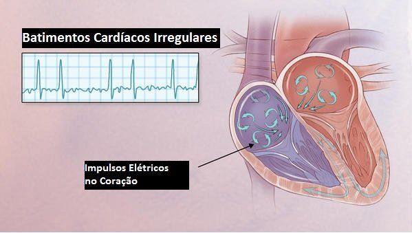 Fibrilação Atrial Fibrilação atrial em Maringá