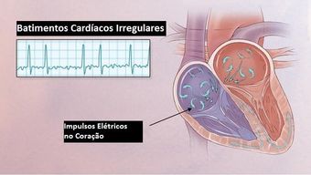 Fibrilação Atrial Fibrilação atrial em Maringá