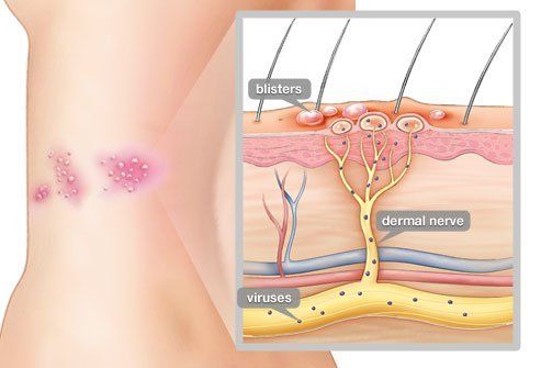 Herpes Zoster Herpes Zoster em Maringá