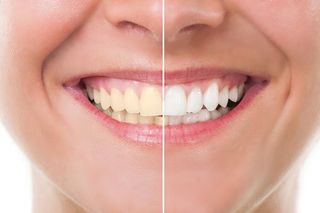 Whitening - Dental Service in Clay, WV Whitening - Dental Service in Clay, WV