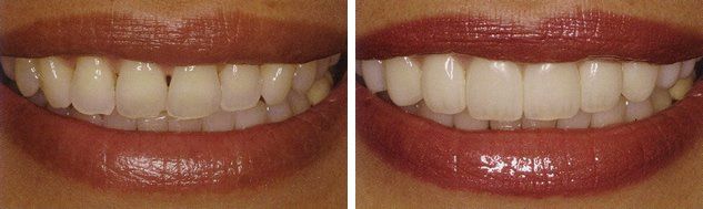 Bondings - Dental Services in Clay, WV