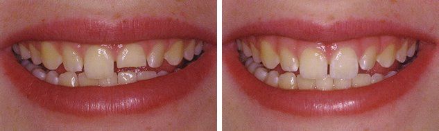 Bonding - Dental Services in Clay, WV