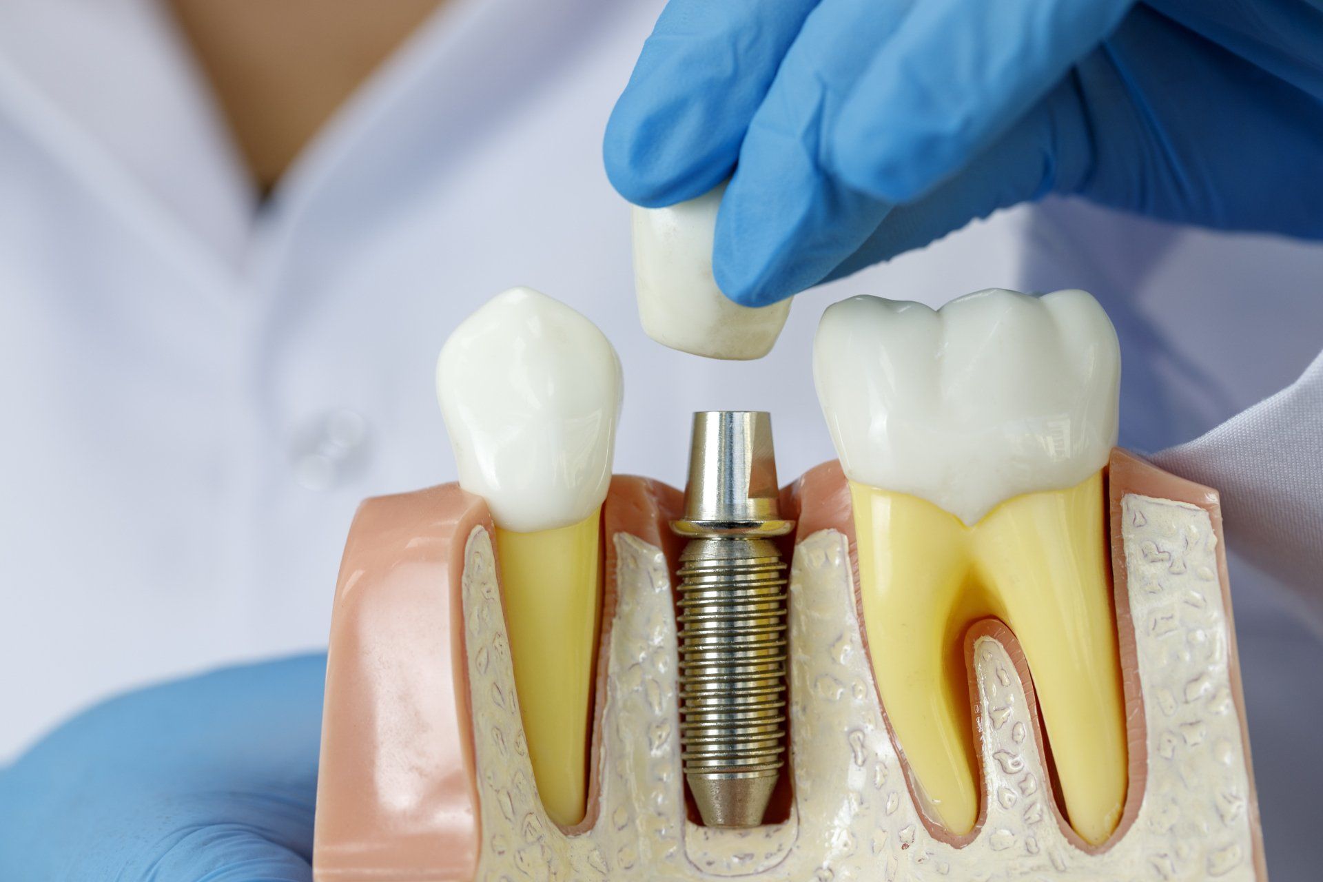 Implant Dentistry sculpture