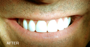 A close up of a man 's mouth with the words after written on the bottom