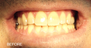 A close up of a man 's teeth with the word before below it