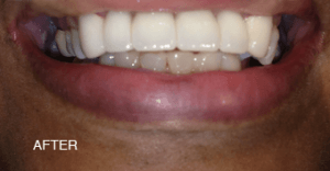 A close up of a person 's mouth with a caption that says after