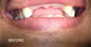 A close up of a person 's mouth with missing teeth.