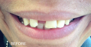 A close up of a person 's mouth with missing teeth.