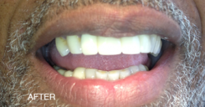 A close up of a man 's mouth with white teeth