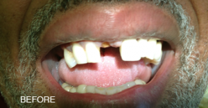 A close up of a man 's mouth with the word before on the bottom