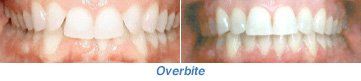A close up of a person 's teeth before and after a bite