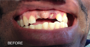 A close up of a man 's mouth with missing teeth.