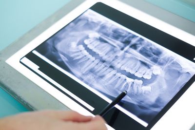 Chipped Teeth — X-Ray Of Teeth in Lexington, NE Chipped Teeth — X-Ray Of Teeth in Lexington, NE