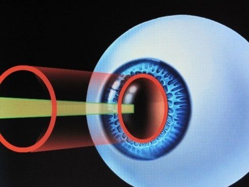 laser