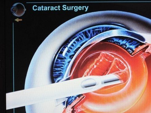 cataratta 3