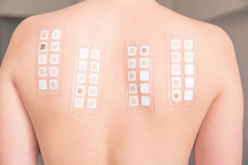 patch test
