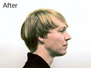 Photo of teen after jaw surgery