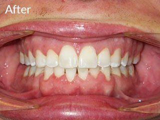 Photo of teen after jaw surgery
