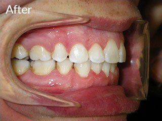 Photo of teen after jaw surgery