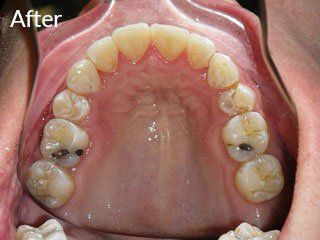 Photo of teen after jaw surgery