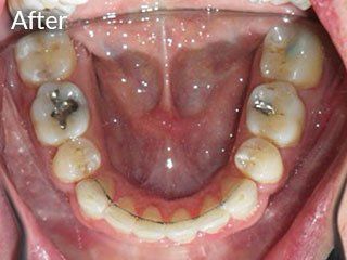 Photo of teen after jaw surgery