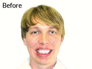Photo of teen before jaw surgery
