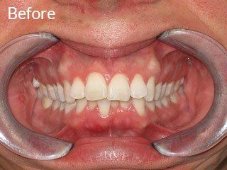 Photo of teen before jaw surgery
