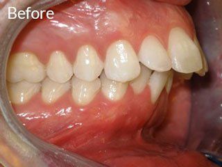 Photo of teen before jaw surgery