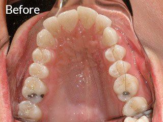 Photo of teen before jaw surgery