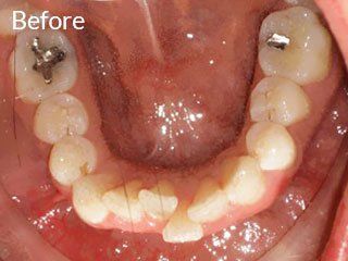 Photo of teen before jaw surgery