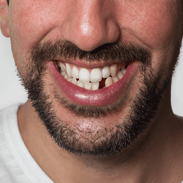 bridges treatment