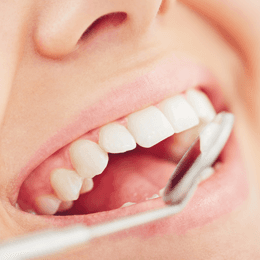 teeth fillings