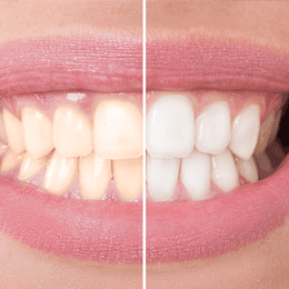 teeth whitening