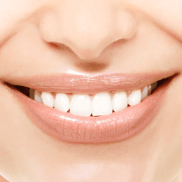 Veneers