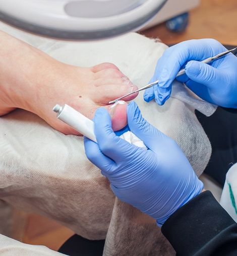 Toenail Treatment — Longmeadow, MA — Dr. Christopher H. Peteros, DPM, LLC Toenail Treatment — Longmeadow, MA — Dr. Christopher H. Peteros, DPM, LLC