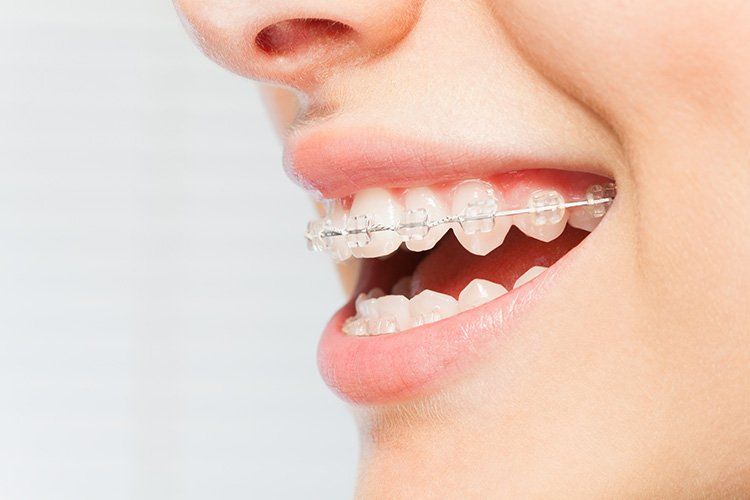 Person smiling, showing teeth with clear braces.