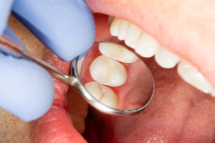 Dentist using a mirror to examine a patient's teeth, revealing a close-up of molars.