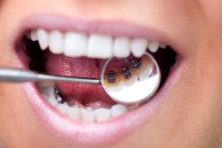 Mouth with braces, being examined with a dental mirror. Pink lips, white teeth.