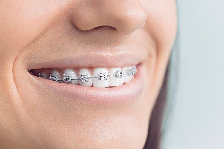 Close-up of a smiling person with metal braces on their teeth.