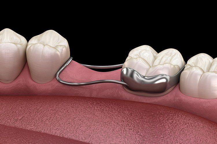 Diagram of a space maintainer in a mouth; a silver metal device holds space for a future tooth.