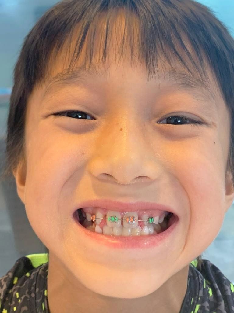 Boy with braces smiles, showing colorful elastics.
