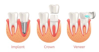 Veneers — Teeth Procedure of Implant Veneer Crown Restoration in Cordova, TN Veneers — Teeth Procedure of Implant Veneer Crown Restoration in Cordova, TN