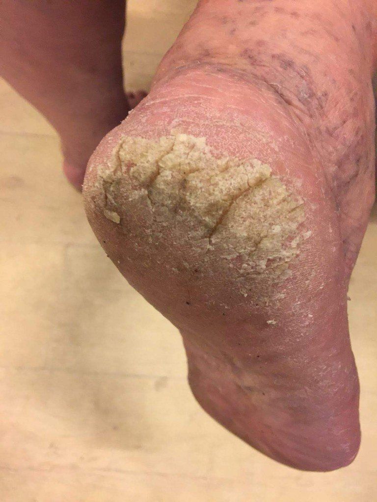 Diabetisch en Risico voet Diabetisch en Risico voet