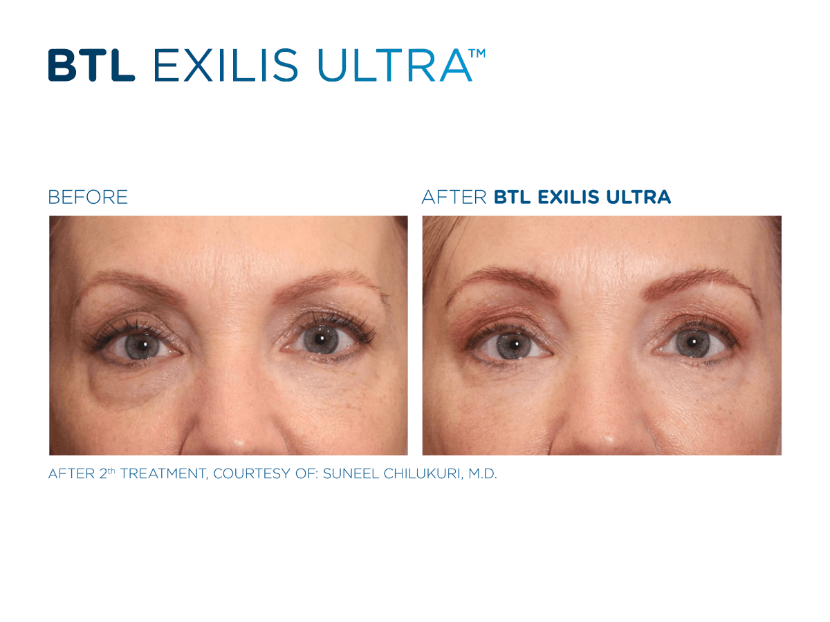 Want quick results? Try Exilis Ultra! One session with radiofrequency and ultrasound can change your skin and body.
