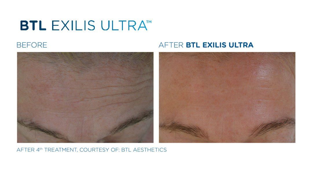 Forehead Treatment — Westerville, OH — Dr. Mantor's Wrinkle and Weight Solutions LLC