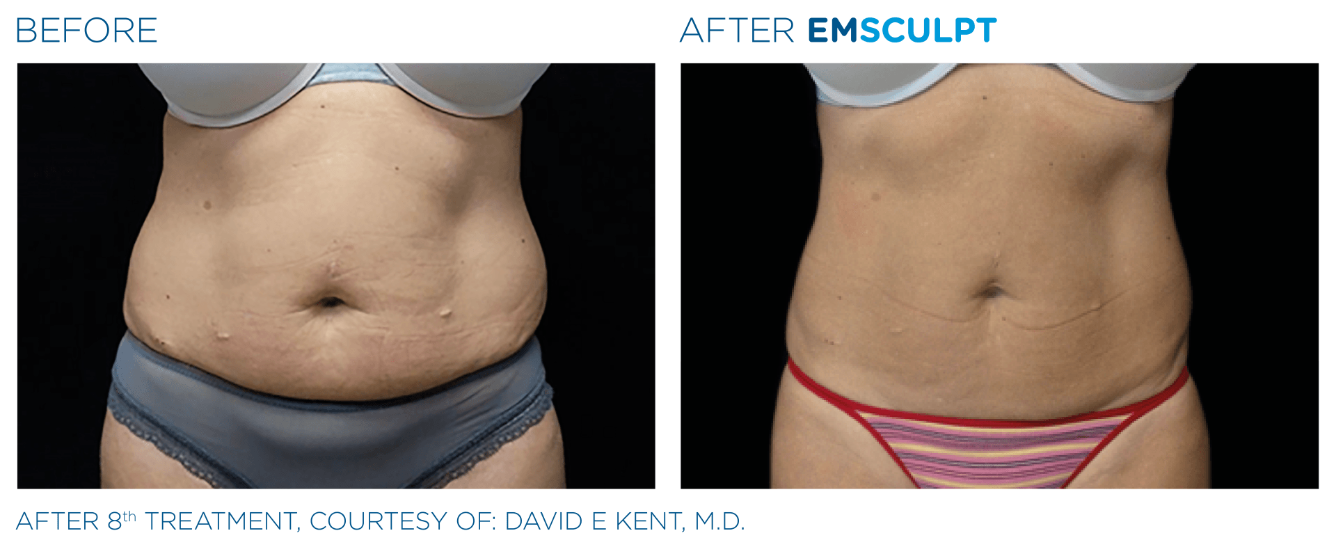 Transform your body with FDA-cleared Emsculpt. Non-invasive, real results since 2008. Try a free session!