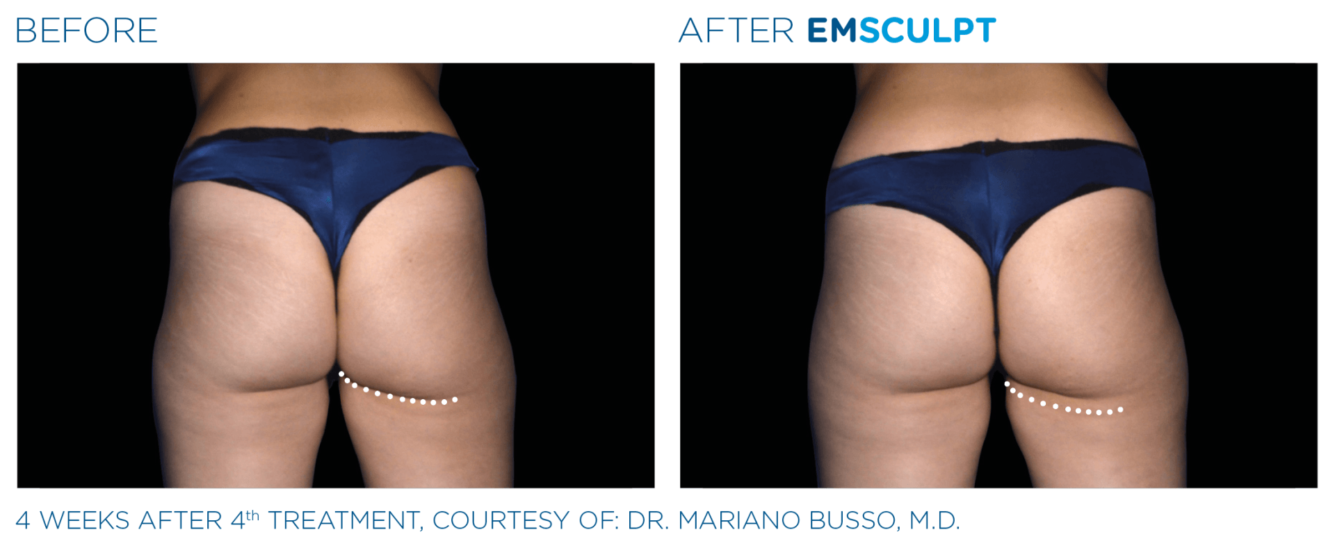 FDA-cleared Emsculpt for non-invasive body sculpting. Achieve real results with a free trial today. Since 2008.