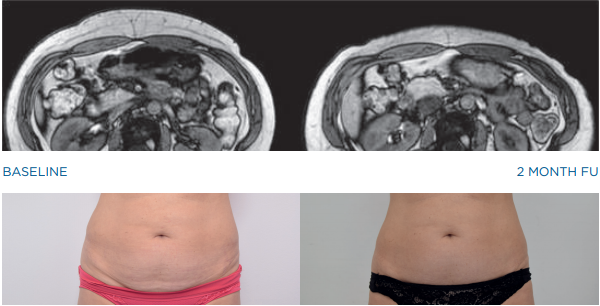 Free trials for advanced body sculpting! Transform your physique at Wrinkle and Weight in Westerville, Ohio.